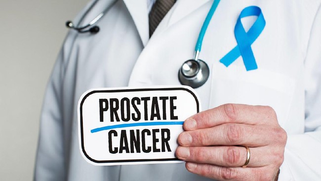 Ilustrasi kanker prostat. (Foto: iStockphoto)