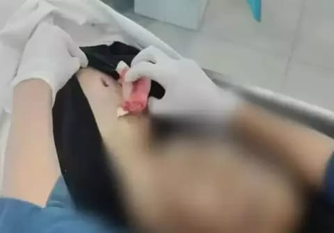 Korban Dijahit Setelah Diserang Geng Motor