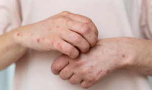 Wabah Baru Mengintai: Mpox Kembali Merebak, Jangan Lengah! Ini Dia Gejala dan Cara Mencegahnya (Kemkes.go.id)