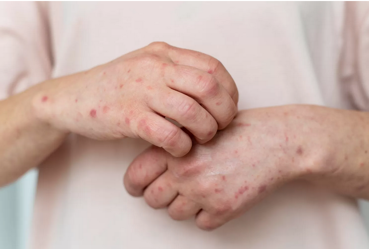 Wabah Baru Mengintai: Mpox Kembali Merebak, Jangan Lengah! Ini Dia Gejala dan Cara Mencegahnya (Kemkes.go.id)