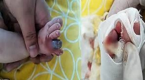 Ibu di China Terkejut Jari Anak Berwarna Hitam, Begini Faktanya (TRIBUNTRENDS.COM)