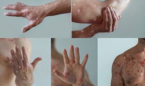Mpox dan Vaksin COVID-19: Kemenkes Buka Suara Tentang Isu yang Beredar
