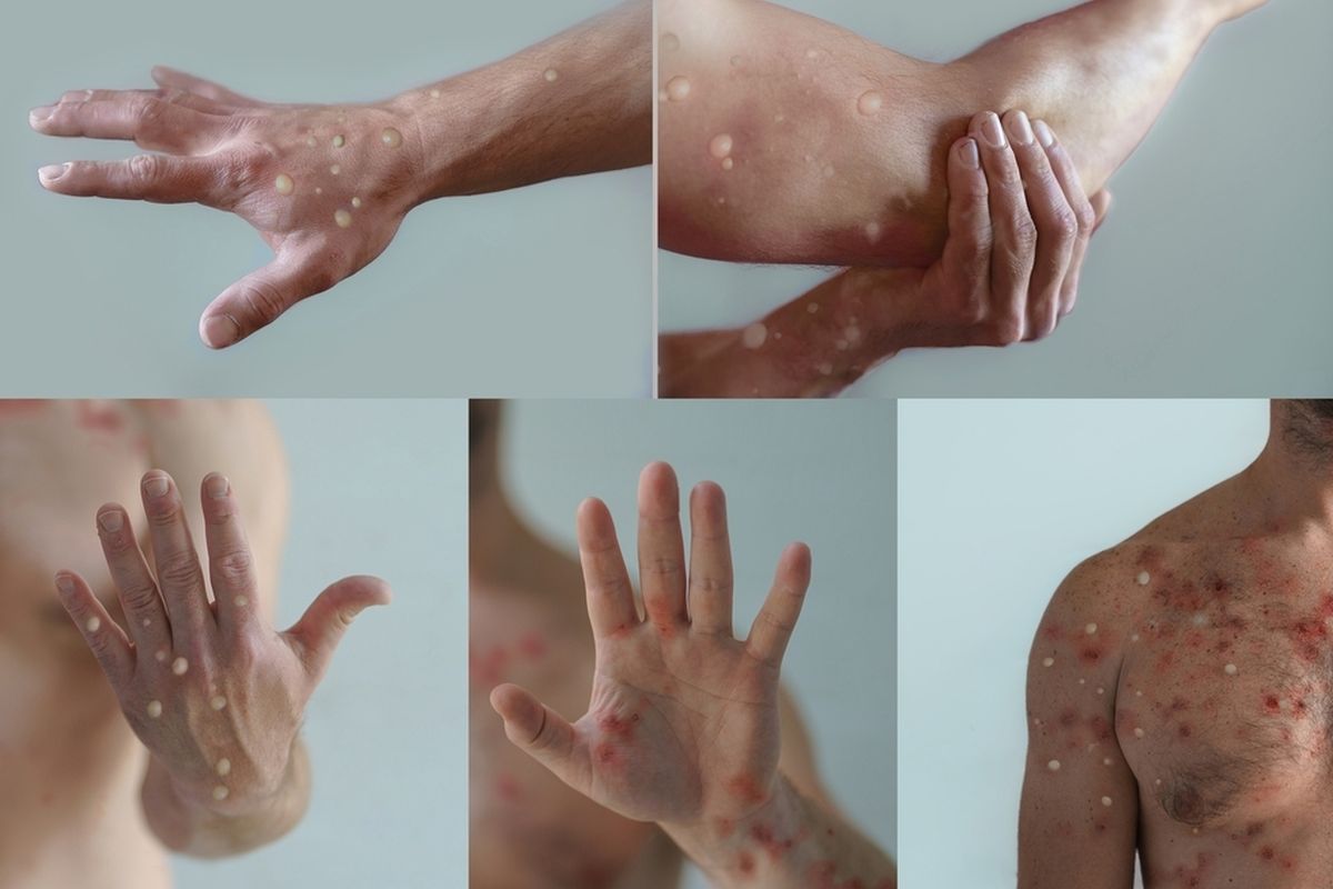 Mpox dan Vaksin COVID-19: Kemenkes Buka Suara Tentang Isu yang Beredar