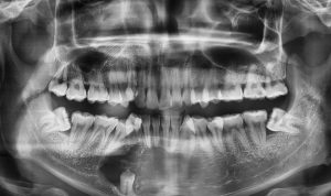 Mengungkap Kista Dentigerous: Risiko, Diagnosis, dan Komplikasi yang Perlu Diketahui