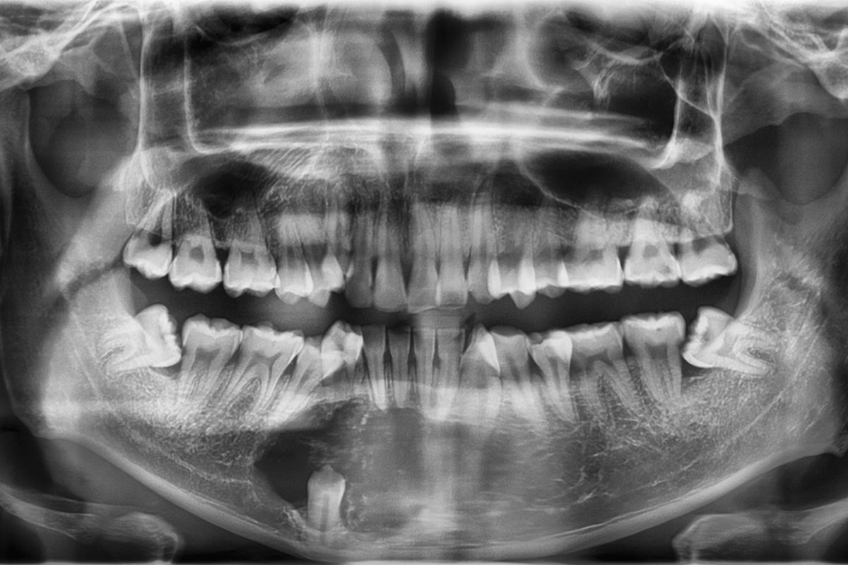 Mengungkap Kista Dentigerous: Risiko, Diagnosis, dan Komplikasi yang Perlu Diketahui