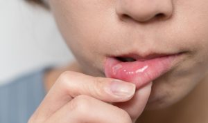 Awalnya Cuma Sariawan, Pria Solo Ini Ternyata Derita Kanker Lidah di Usia 33 Tahun