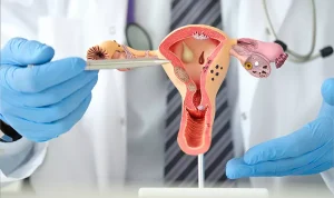 Mengenal Ciri-Ciri PCOS pada Wanita dan Pentingnya Deteksi Dini