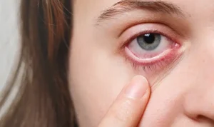 Penyebab Uveitis dan Cara Mengobatinya, Waspadai Peradangan Mata yang Berbahaya