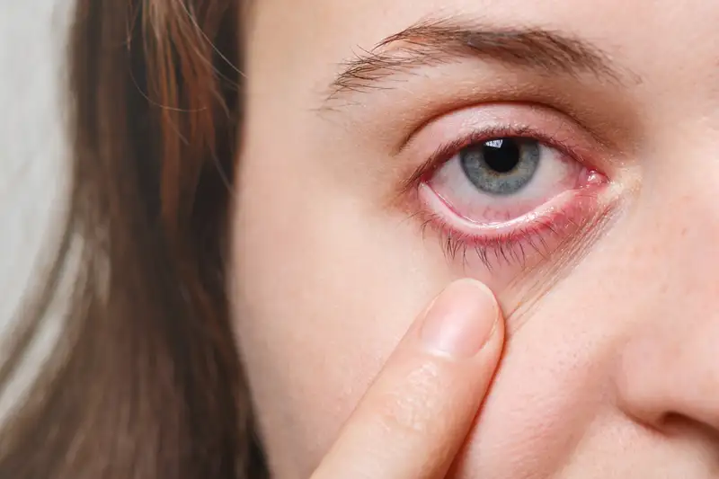 Penyebab Uveitis dan Cara Mengobatinya, Waspadai Peradangan Mata yang Berbahaya