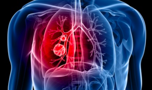 Ilustrasi kanker paru, Pneumonia