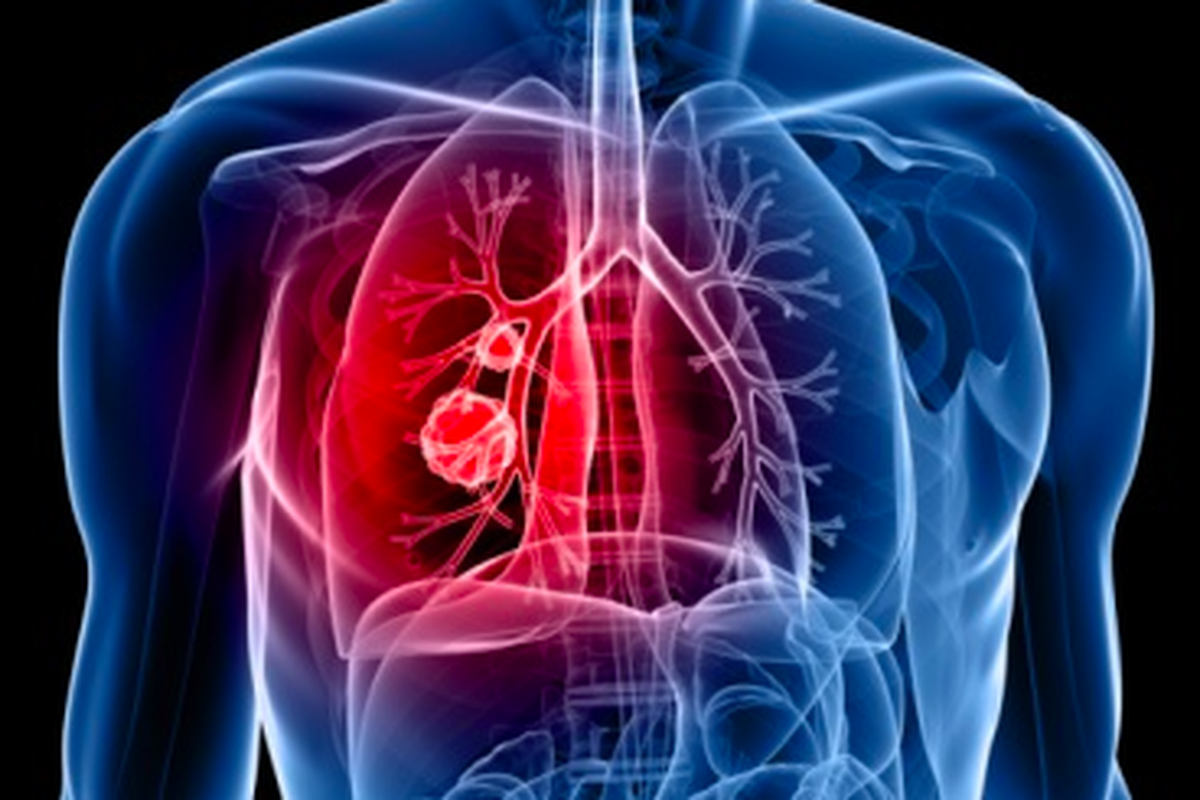 Ilustrasi kanker paru, Pneumonia