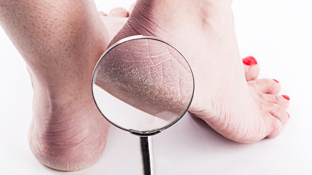 Cara Mengatasi Kaki Pecah-Pecah yang Mudah, Simak Tipsnya!
