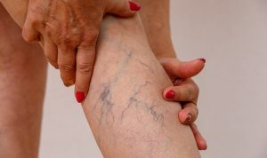 Cara Menghilangkan Varises di Kaki, Ini Solusinya!