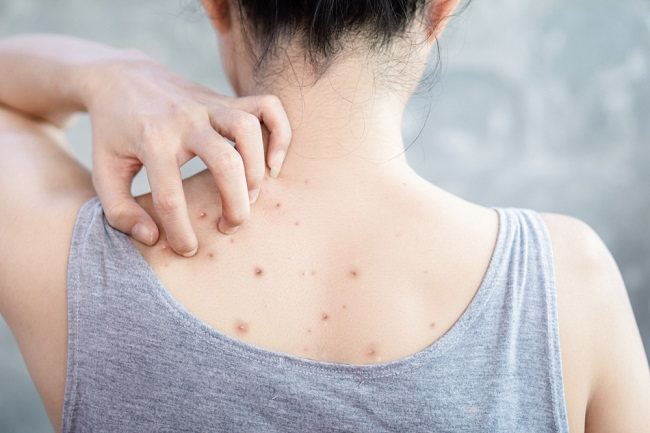 Penyebab Tiba-Tiba Gatal Seluruh Badan dan Cara Mengatasinya