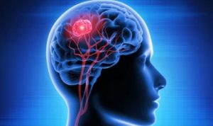 Waspada Tumor di Kepala! Kenali Gejala dan Cara Pengobatannya