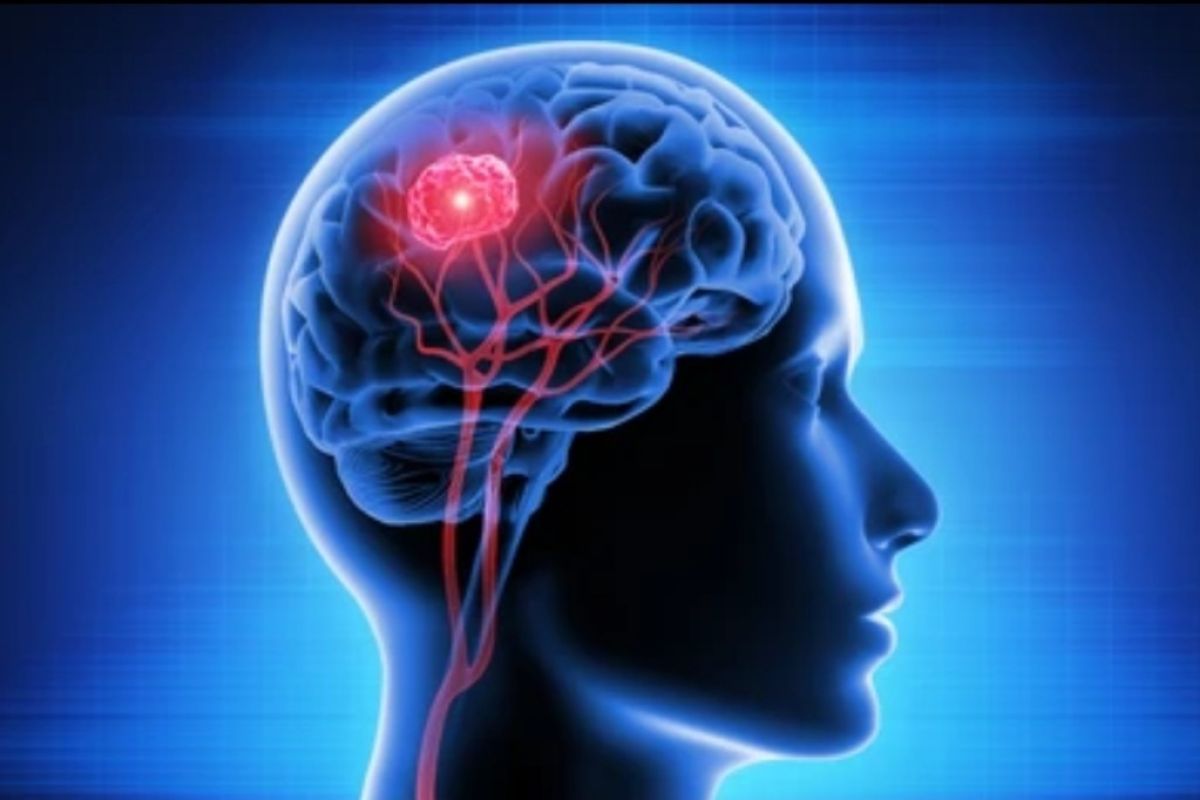 Waspada Tumor di Kepala! Kenali Gejala dan Cara Pengobatannya