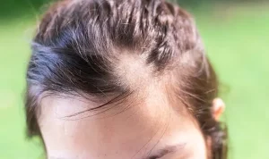 Trikotilomania: Gangguan Mental yang Dapat Menyebabkan Kebotakan, Kenali Penyebab dan Cara Mengobatinya