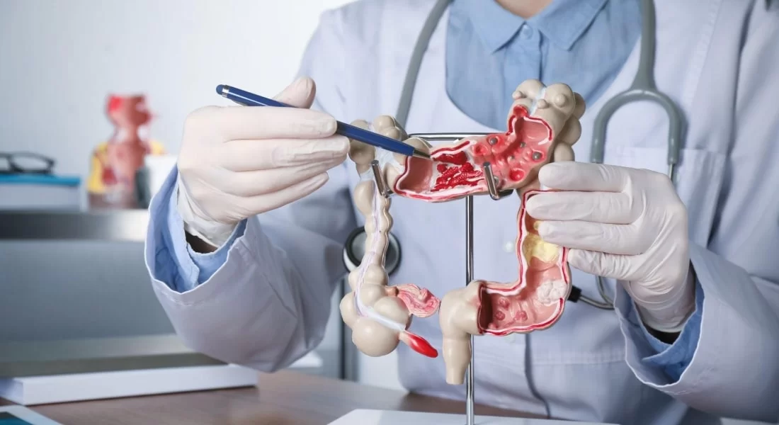 Kanker Usus Besar: Gejala, Penyebab, Diagnosis, dan Pengobatan yang Wajib Diketahui