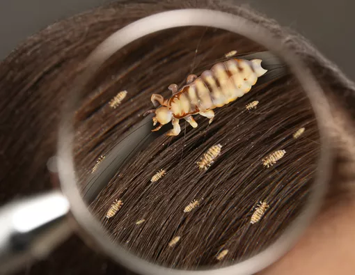 Kutu Rambut, Solusi Mengatasi Gatal dan Penularannya dengan Benar