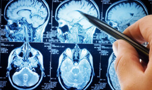 Remaja Skotlandia Alami Perut Kembung, Ternyata Didiagnosis Tumor Otak Langka