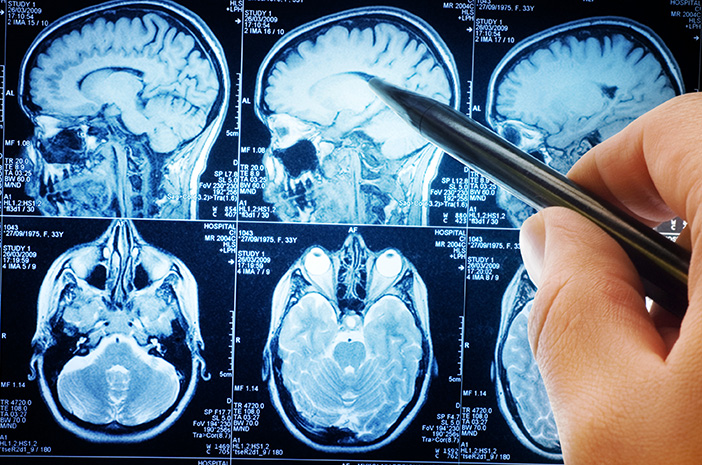 Remaja Skotlandia Alami Perut Kembung, Ternyata Didiagnosis Tumor Otak Langka
