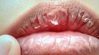 bibir kering (kompasiana)
